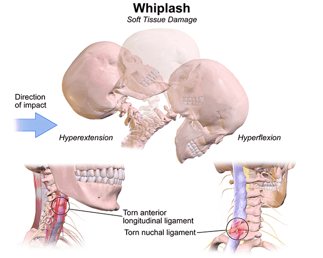 A 3D rendering of how a whiplash injury occurs