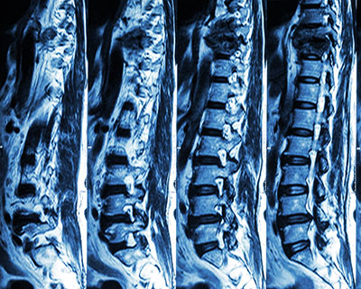 spinal cord injury treatment