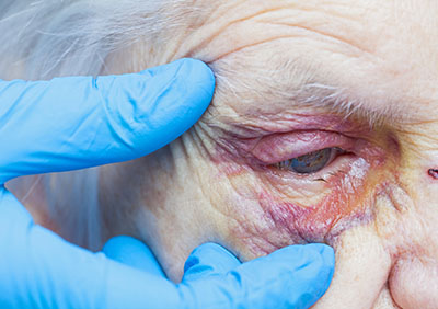An elderly nursing home resident receiving treatment for a black eye.