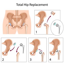 Hip Recall Attorneys