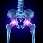 hip replacement  failure xray