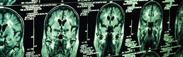 Traumatic brain injury FAQ